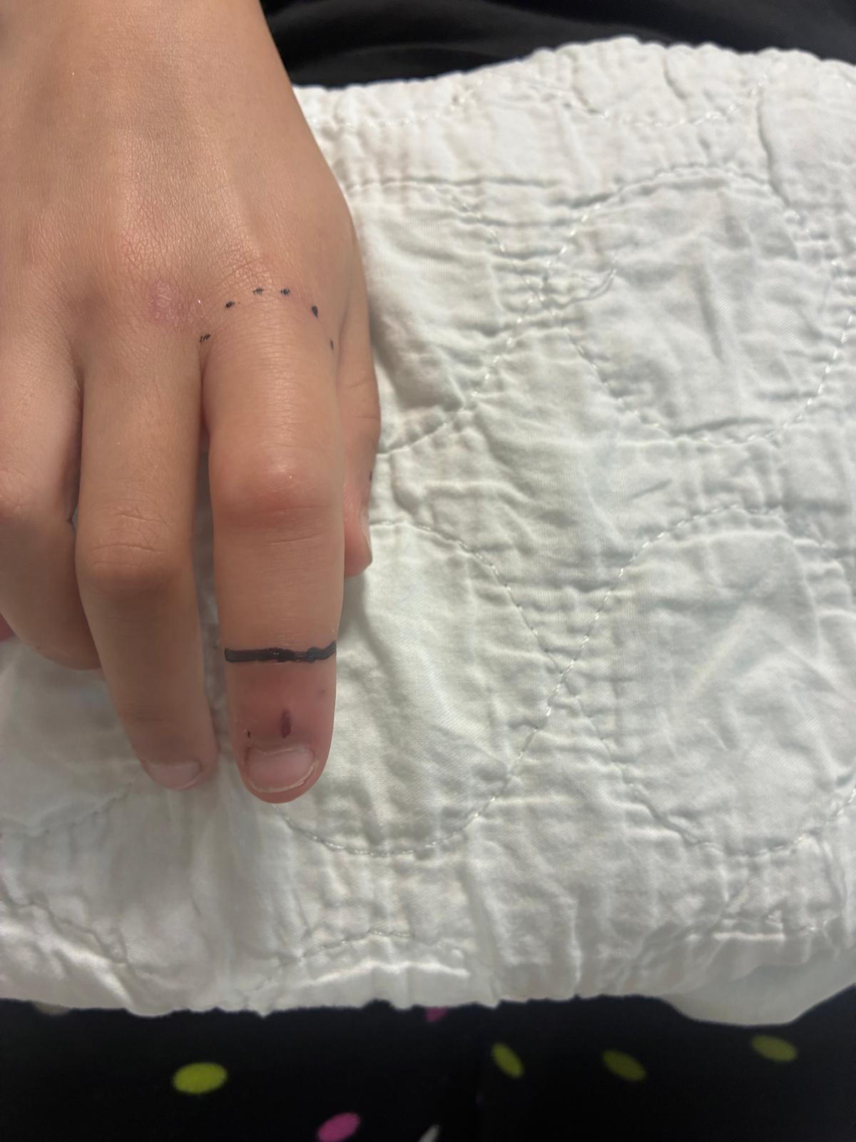 Il morso sulla mano della bambina.jpg